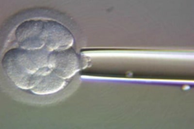 PGD to avoid the risk of chromosomal abnormalities in cases of advanced age